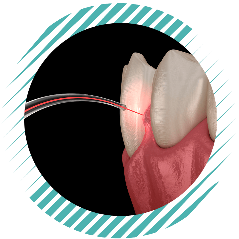 lanap surgery cir