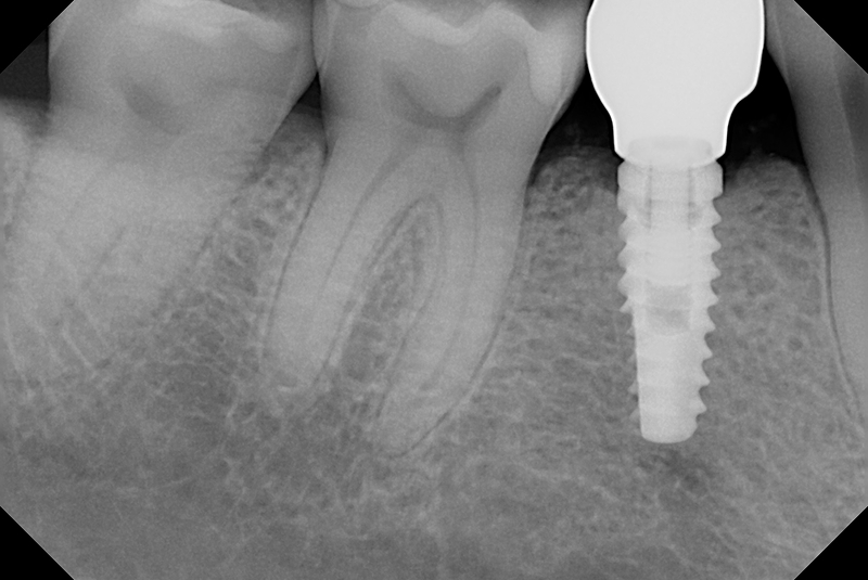After Crown Placement