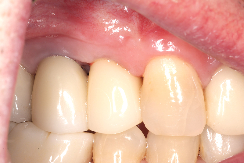 After Crown Placement Photo