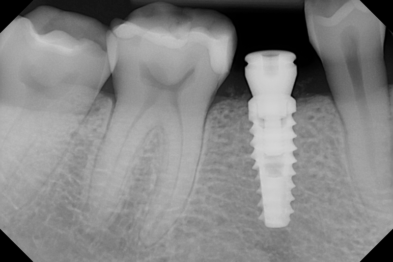 Implant x-ray