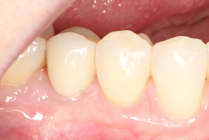 Final Crown Placement