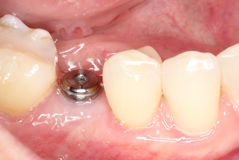 Healing Period - implant only